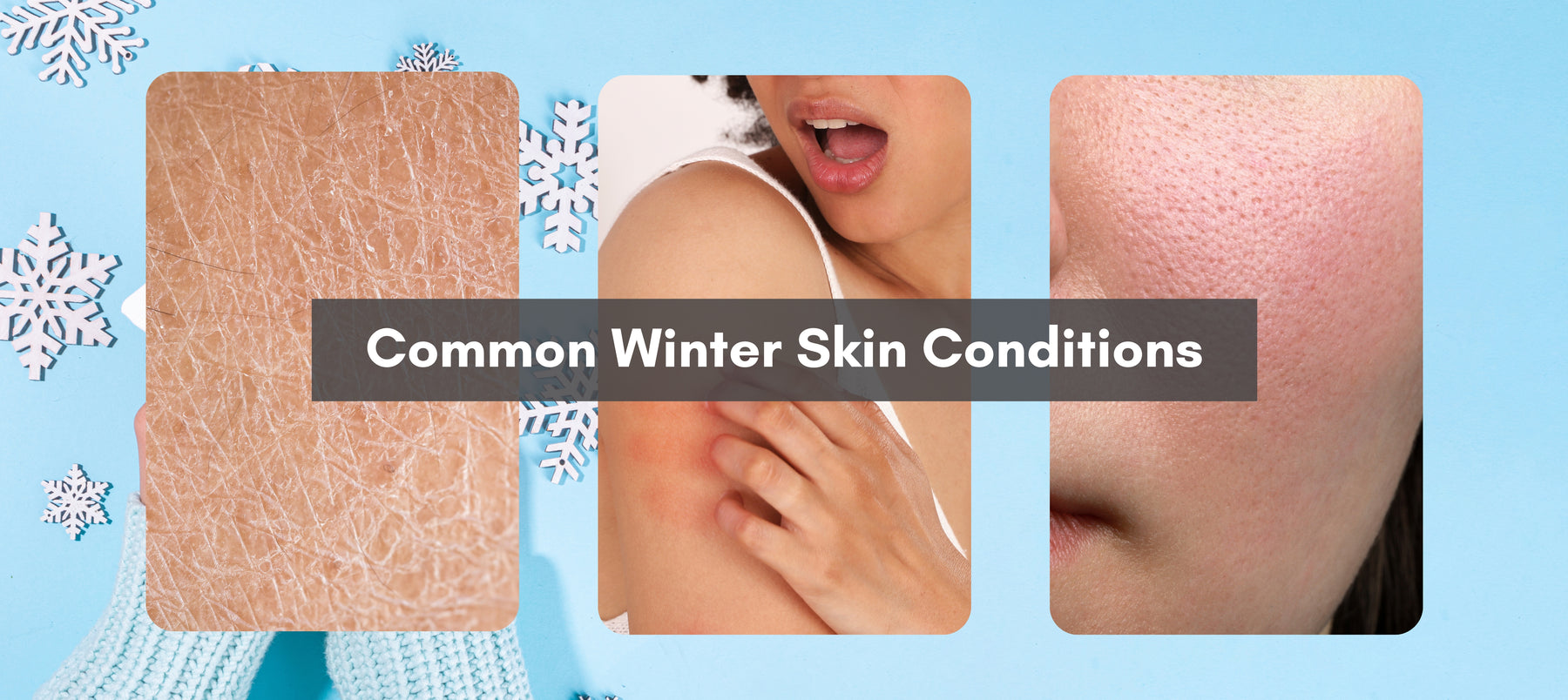 Unraveling Winter’s Skin Woes: Understanding Common Cold-Weather Skin Conditions
