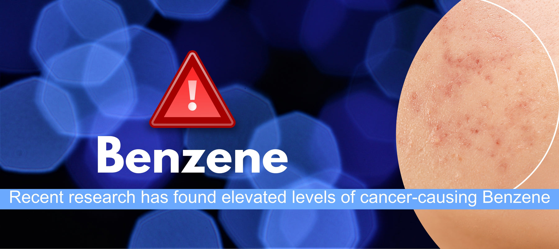 Carcinogenic to Humans: Benzene Found In Benzoyl Peroxide Acne Treatments:Study