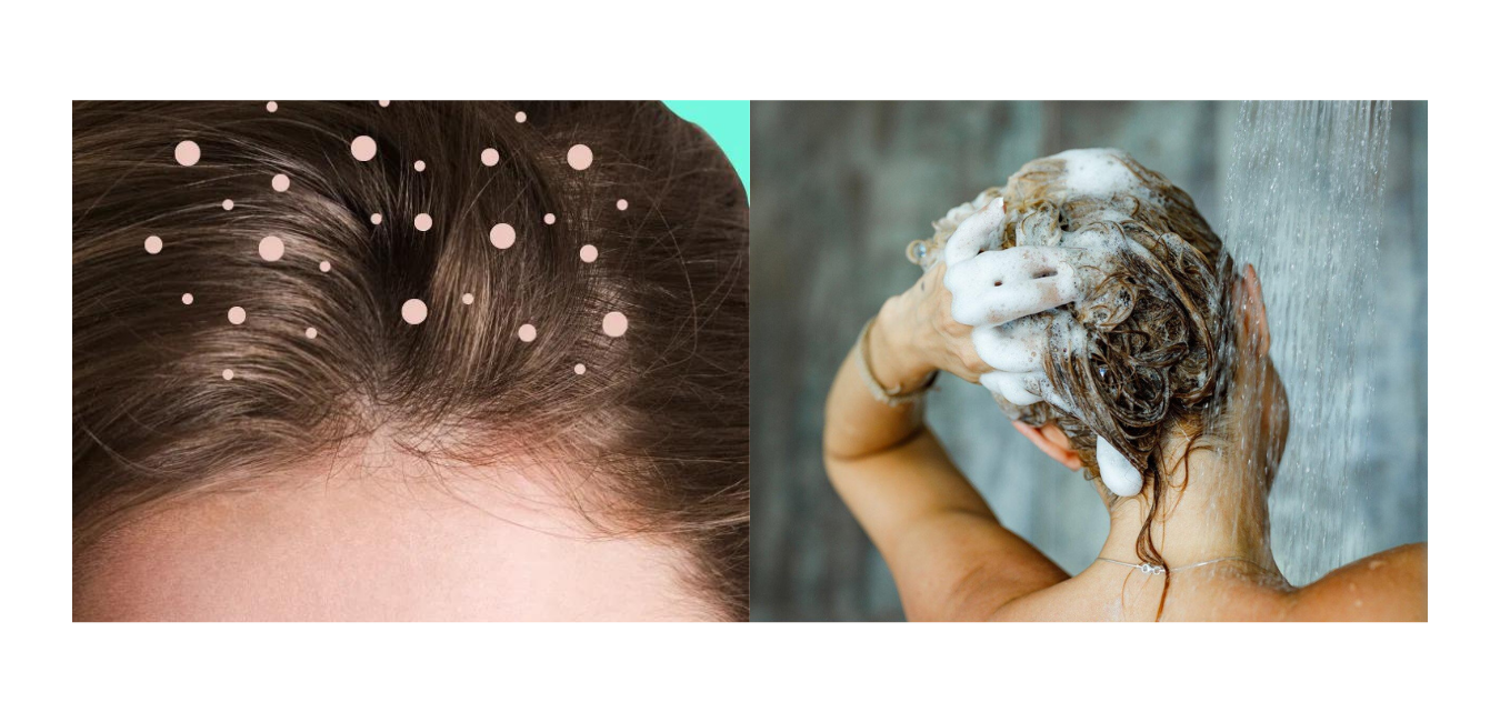 Get Rid of Dandruff with Zinc Pyrithione?