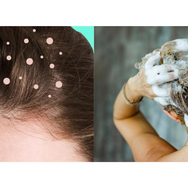 Get Rid of Dandruff with Zinc Pyrithione?