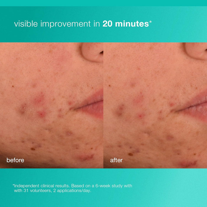 Dermalogica Acne Biotic Moisturizer