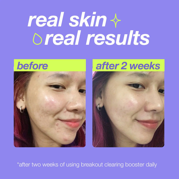 Dermalogica Clear Start Breakout Clearing Booster delivers real results. Before and after results show clearer and less breakouts