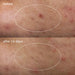 Dermalogica Deep Acne Invisible Liquid Patch can clear deep acne spots after 14 days. Image shows the disappearance of the spot.