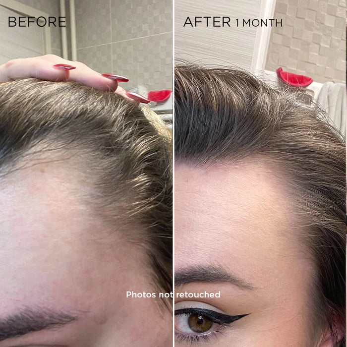Before and After 1 month of use results