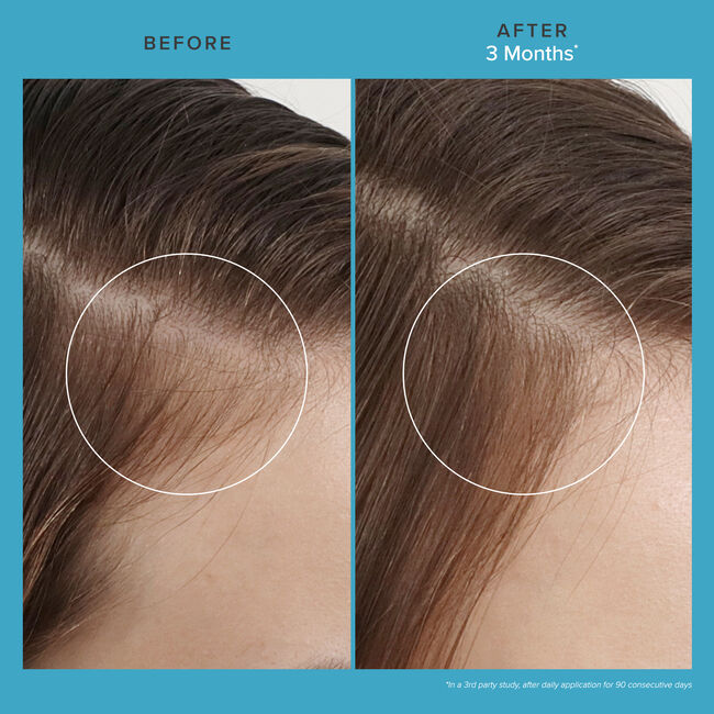 Living Proof Scalp Care Revitalizing Treatment before and after 3 months of use