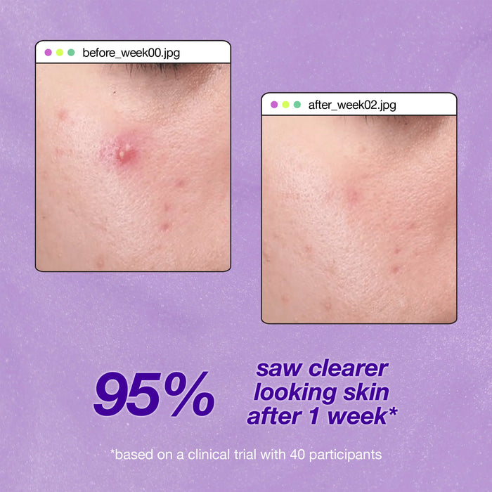 Dermalogica Breakout Clearing Liquid Peel before and after 1 week on a clinical trial with 40 participants